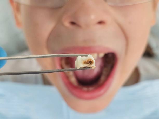 Best Broken Tooth Emergency  in Ashville, OH